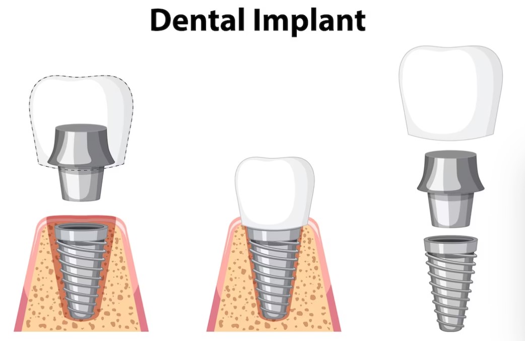 Affordable Dental Implants in Bateman, Perth Low Cost Dental Implant Surgery