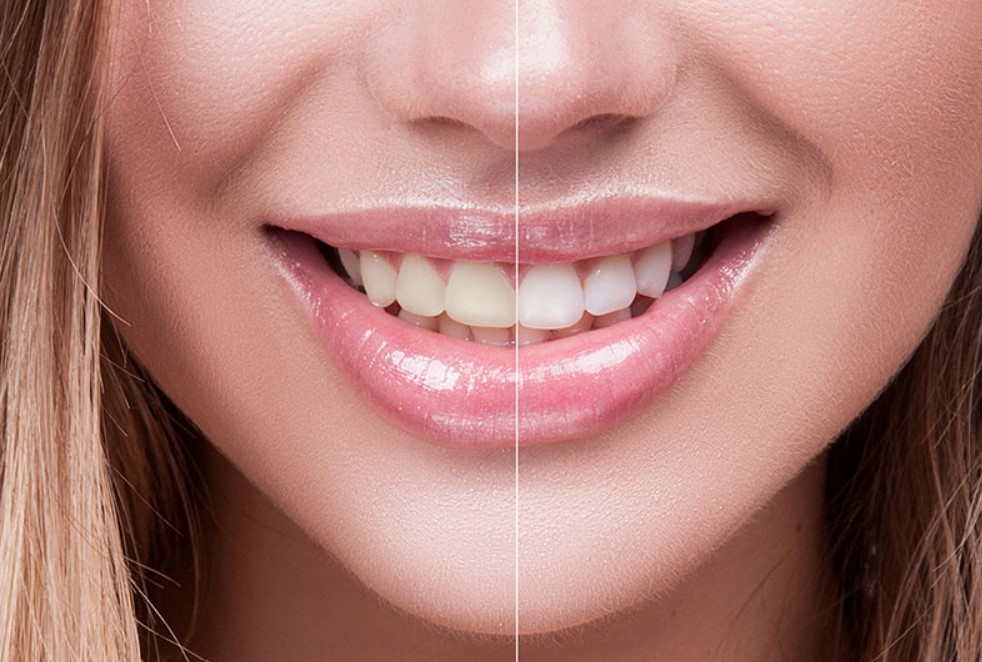 Teeth Whitening in Bull Creek