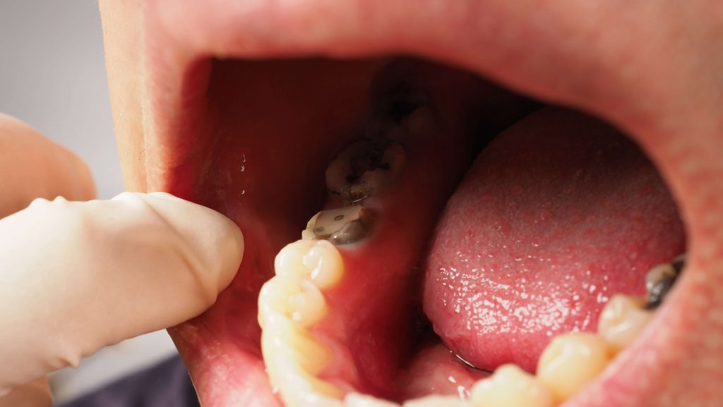 Dental Extraction in Rossmoyne Book Online Now Affordable Dental Care, Friendly & Professional Environment