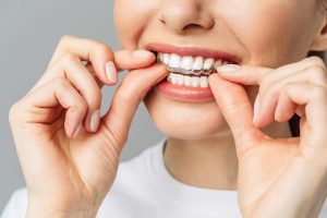 Read more about the article Invisalign Dentist in Applecross: The Key to Straightening Your Teeth Discreetly