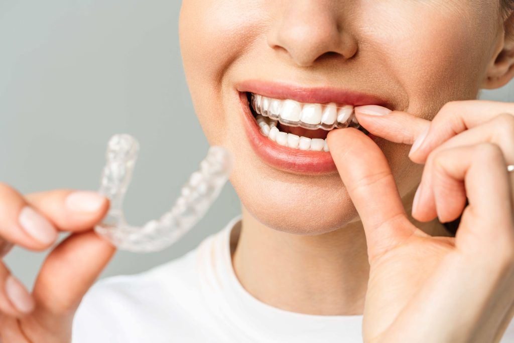 Smile Confidently with Invisalign Discover the Benefits of an Invisalign Dentist in Willetton