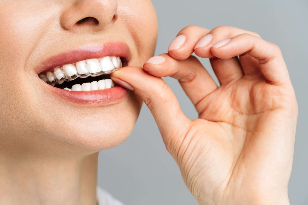 Smile Confidently with Invisalign: Discover the Benefits of an Invisalign Dentist in Willetton