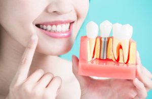 Read more about the article Smile confidently with affordable dental implants in Brentwood: Your guide to restoring your smile