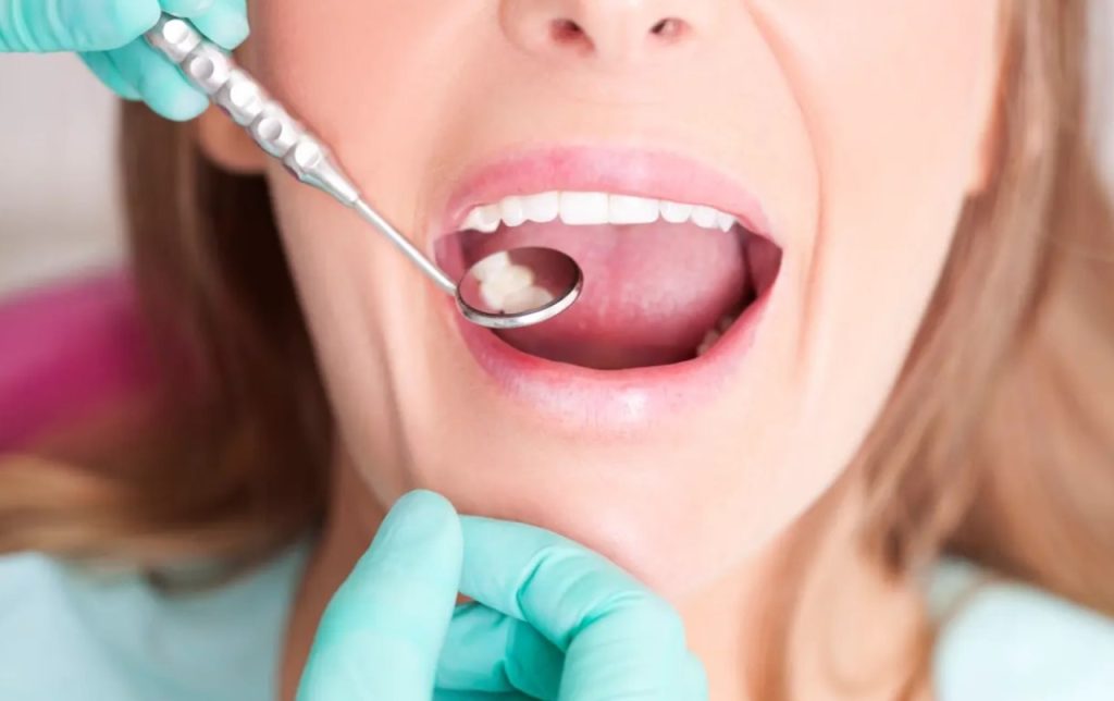 Dental Emergency Services in Bateman: How Many Fillings is Normal at 30?