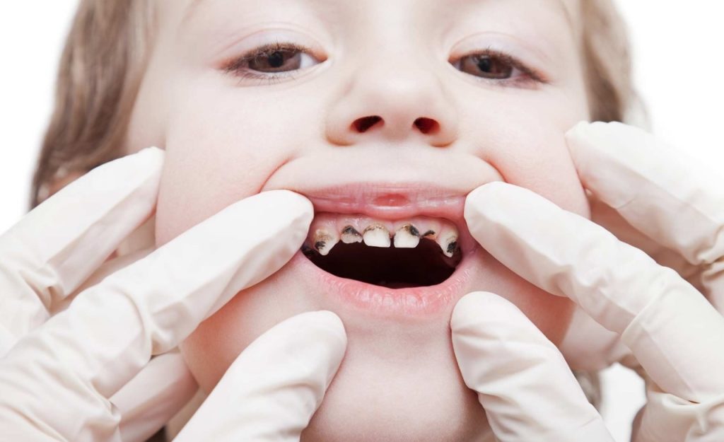 Kid Dentistry Mount Pleasant: Is 10 cavities a lot?