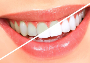 Read more about the article How Does Teeth Whitening Work and What Are the Best Options for a Brighter Smile?