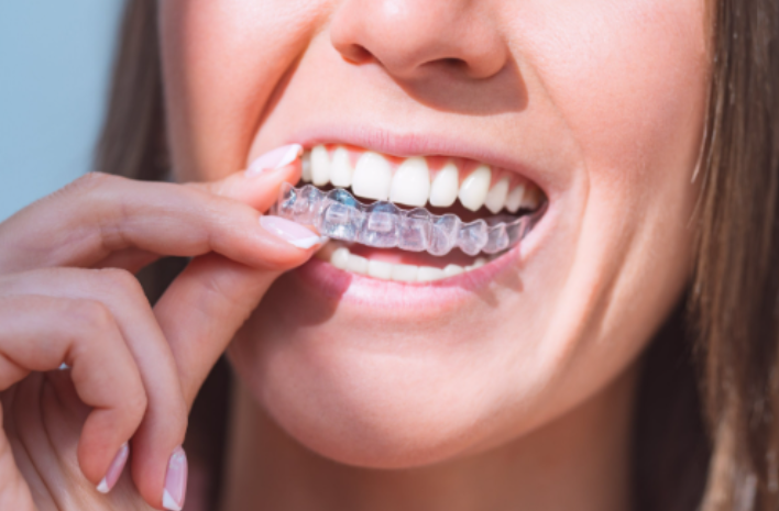 Invisalign Treatment