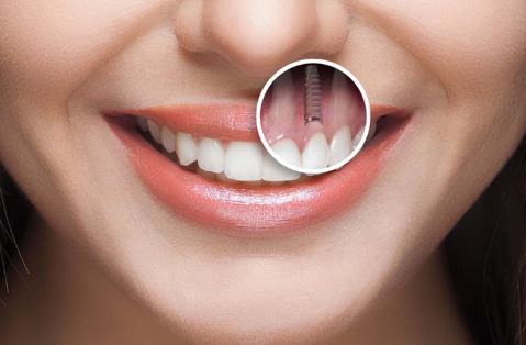 Affordable Dental Implants in Willetton Restore Your Smile Today