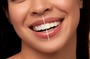 Read more about the article Teeth Whitening in Riverton: Is Laser Teeth Whitening Safe and Effective?