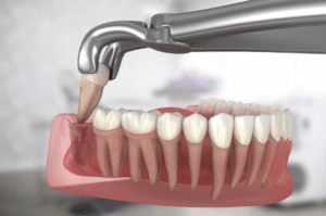 Read more about the article Wisdom Teeth Removal Mount Pleasant: How Painful is Wisdom Teeth Removal?