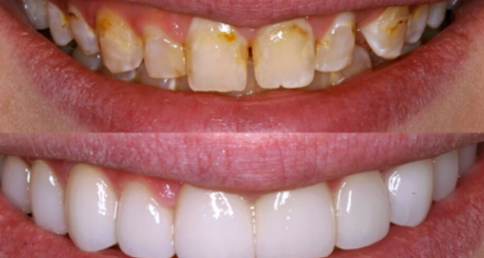 Dental Veneers