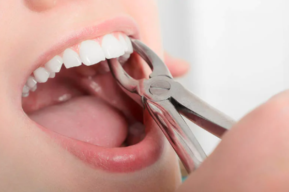 Dental Extraction