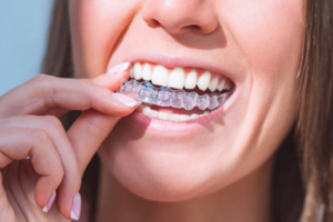Read more about the article Invisalign Treatment Mount Pleasant: Is Invisalign Better Than Braces?
