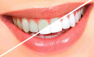 Read more about the article Top Questions People in Applecross Ask About Teeth Whitening