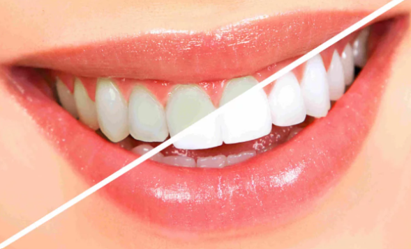 Teeth Whitening