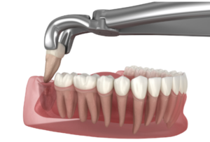 Read more about the article Wisdom Teeth Removal Applecross: When Do You Need Wisdom Teeth Removal?